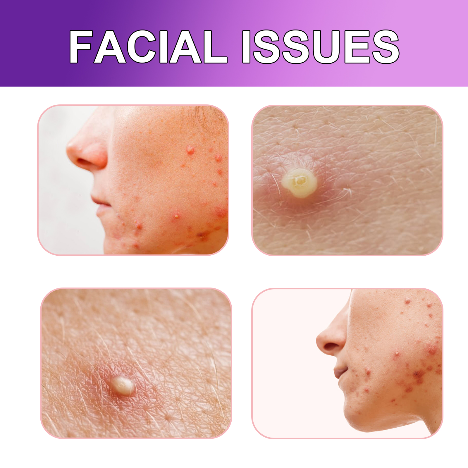 Jaysuing Acne Patches, Lightening Facial Acne Pimples Closed Repair Balance Skin Delicate Pore Care photo 4